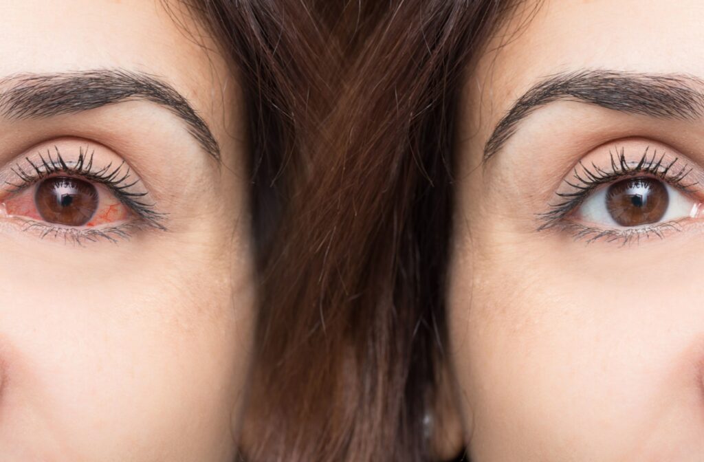 A comparison of a woman's healthy eye and a woman's visibly red and dry eye