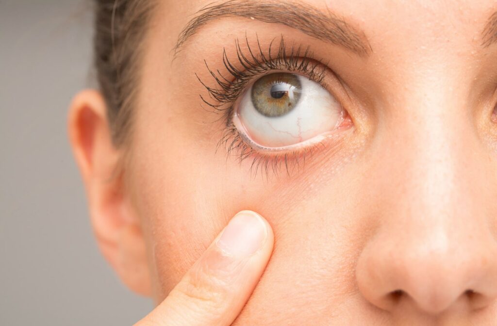 A woman slightly pulling down her eyelid to expose her dry eyes