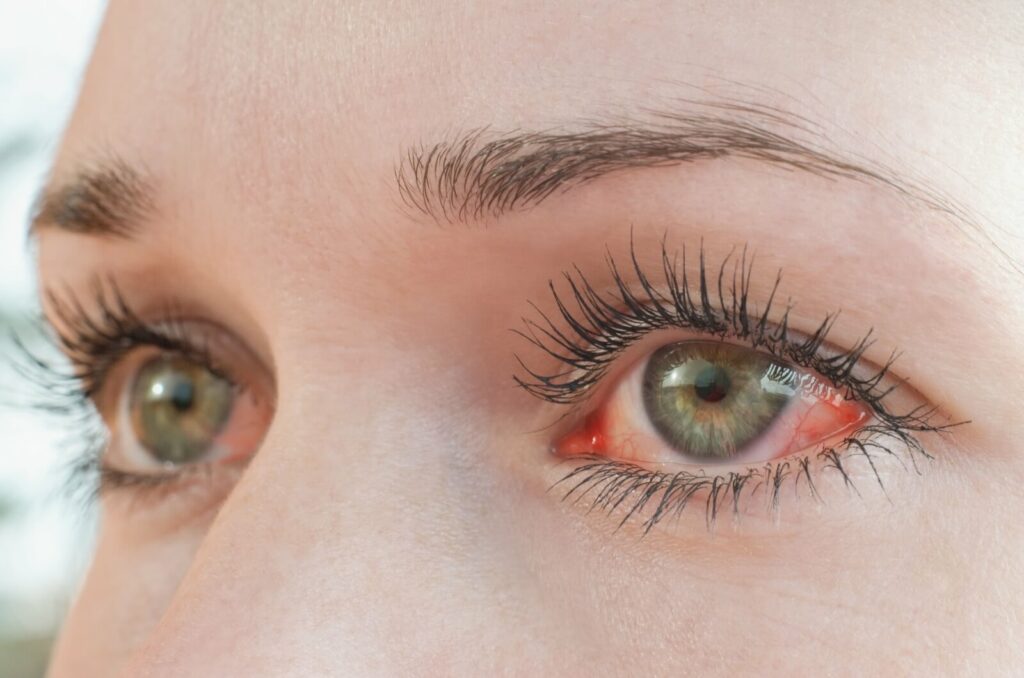 Close-up of a patient’s green eyes. The whites are bright red eyes, showing irritation from dry eye symptoms